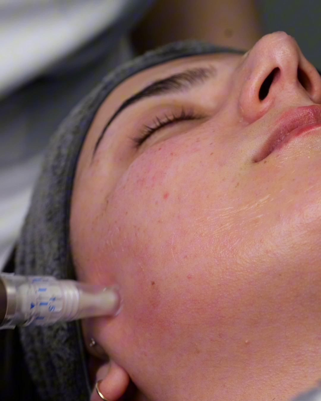Microneedling-behandling med mikronålspenna mot kinden